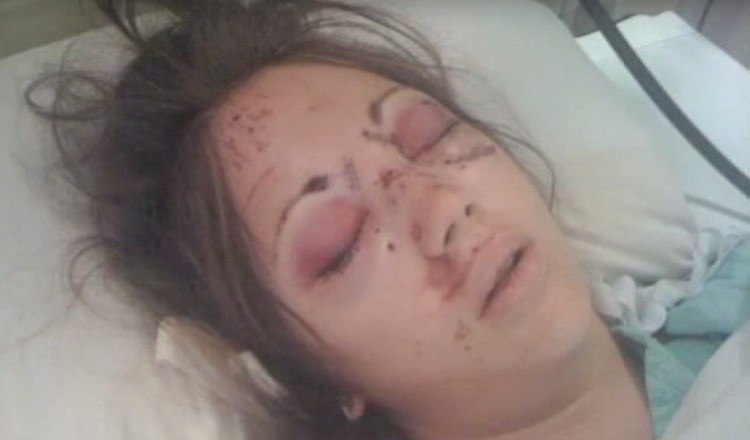 Bethany after the accident